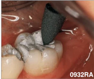 Amalgam Reducer