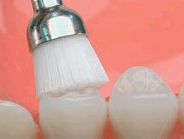 Nylon Brush - pulidor de superficies oclusales y proximales