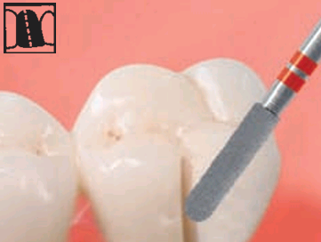 K-Diamonds KF856 / KF881 (cortacoronas de zirconio)
