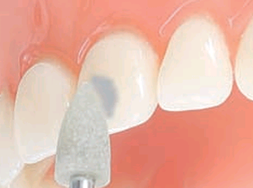 OrthoFlex - Para la eliminación segura y cuidadosa del adhesivo residual sin dañar la sustancia dental