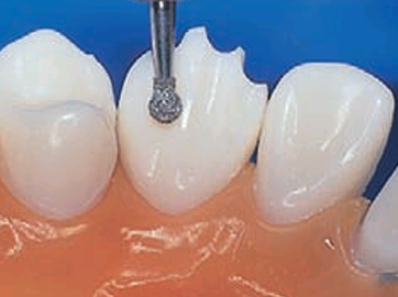 Diamante 802 (bola con extensión)